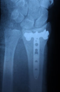 внутрисуставной перелом лучевой кости после операции